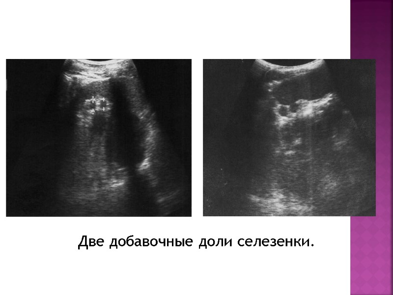 Две добавочные доли селезенки.